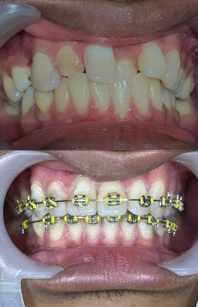 Braces-zero-deposit-lovedental-bangi-klinik-gigi-01