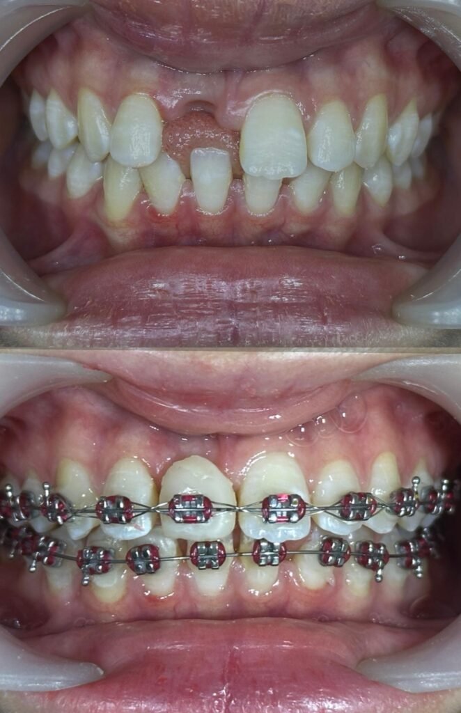 Braces-zero-deposit-lovedental-bangi-klinik-gigi-02