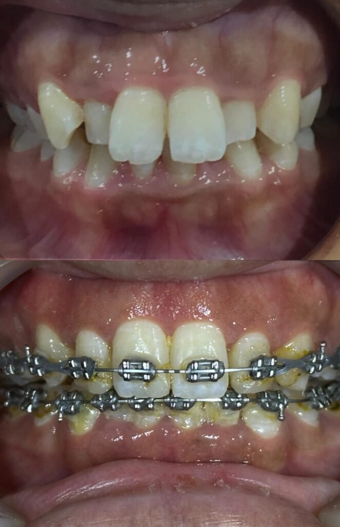 Braces-zero-deposit-lovedental-bangi-klinik-gigi-03