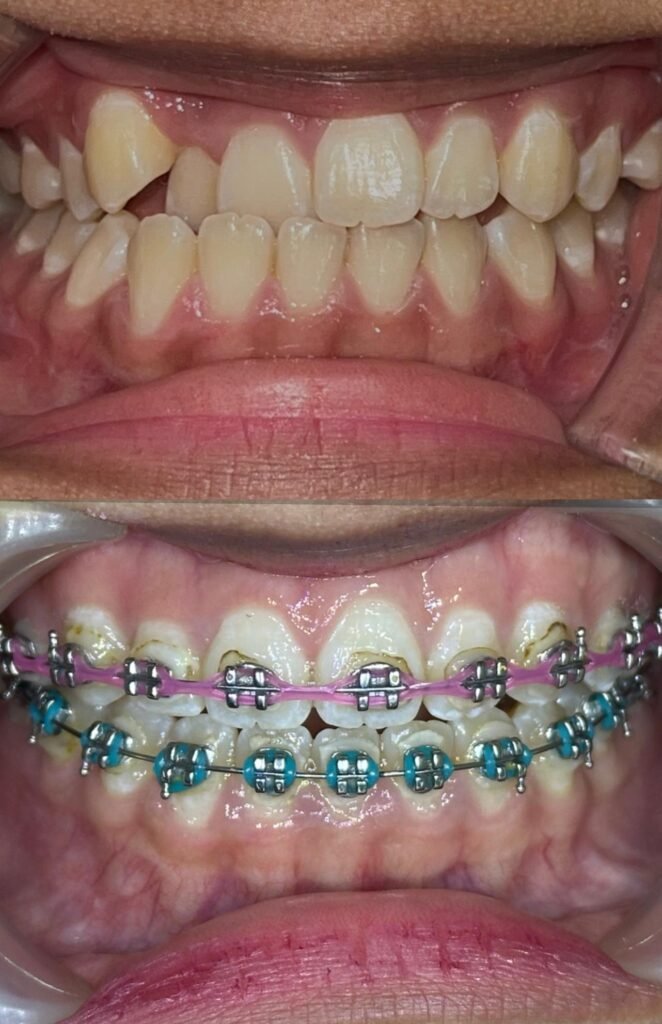 Braces-zero-deposit-lovedental-bangi-klinik-gigi-04