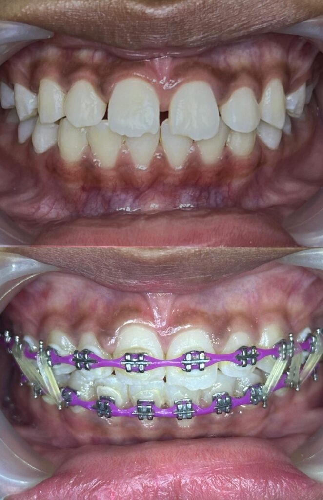 Braces-zero-deposit-lovedental-bangi-klinik-gigi-05