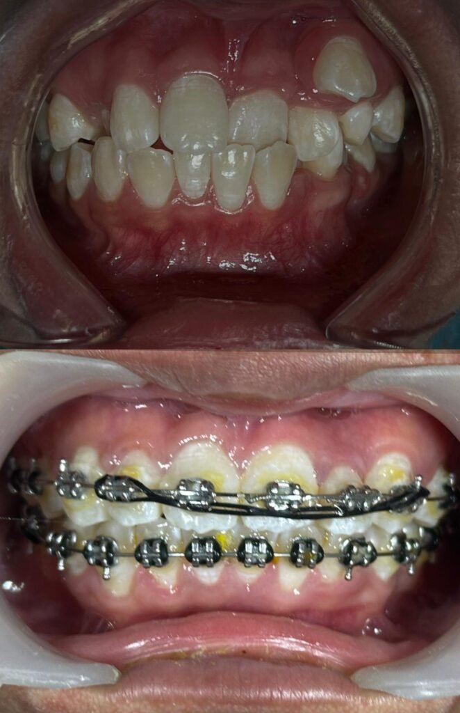 Braces-zero-deposit-lovedental-bangi-klinik-gigi-06